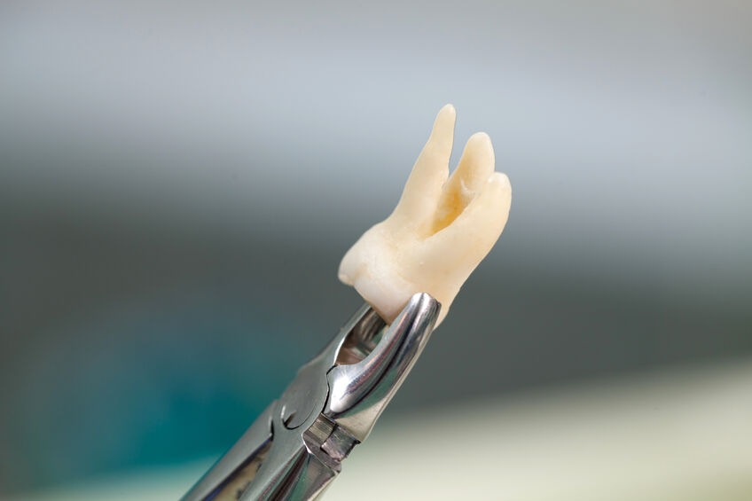 Lost tooth being held with dental equipment