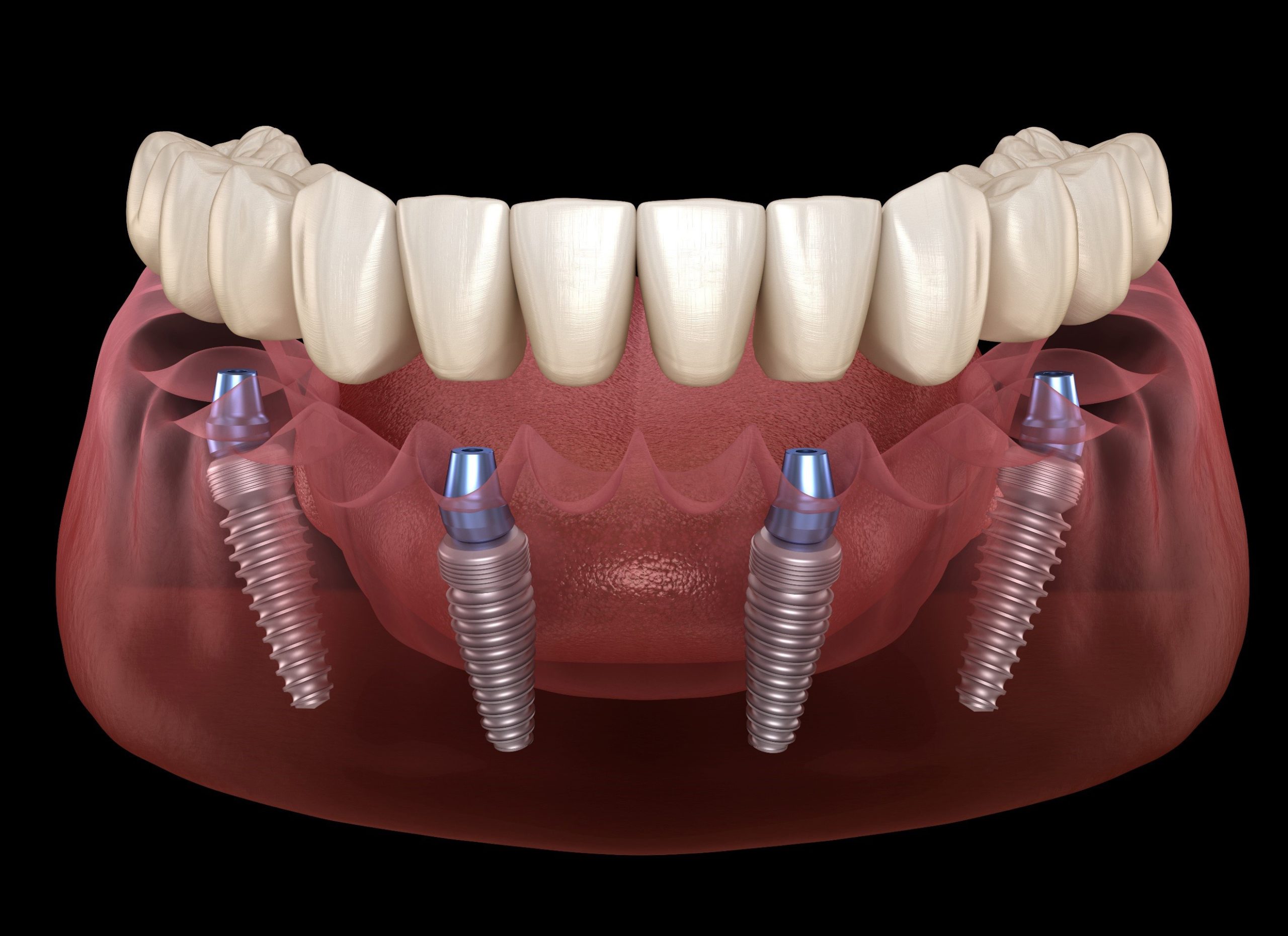 All-On-4 dental implant