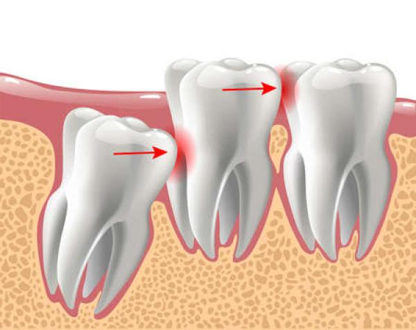 A diagram of a third molar that's coming in at an odd angle and doesn't have room to fully erupt