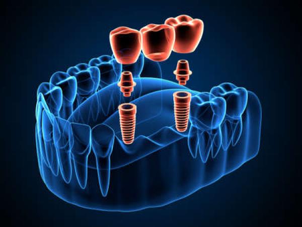 A visual representation of an implant-supported bridge