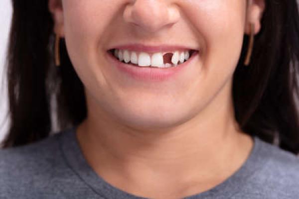 A closeup photo of a woman missing a tooth