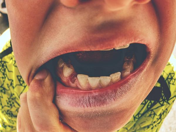 A man shows off a missing canine tooth