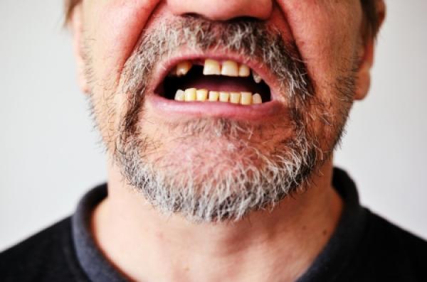 A man smiles to show off a missing tooth