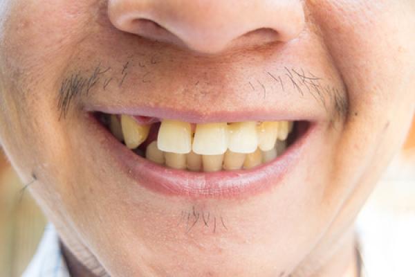 A man smiles, showing off his missing tooth