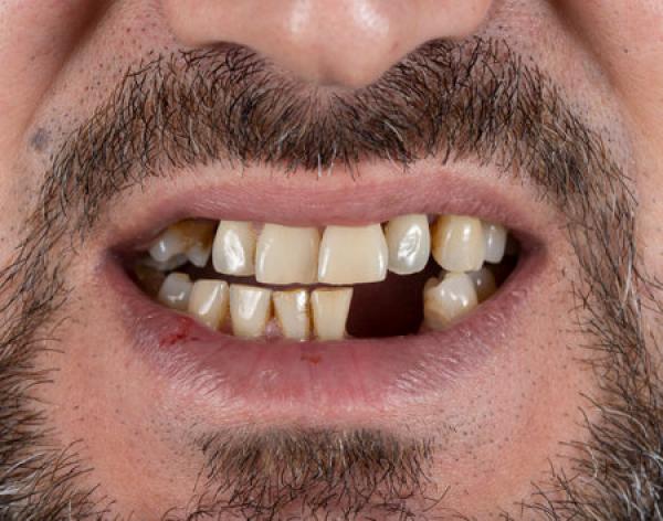 Closeup of a man missing a tooth on the bottom row